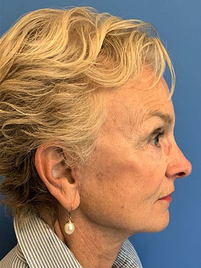 Face & Neck Lift Case 713 After Photo Face & Neck Lift