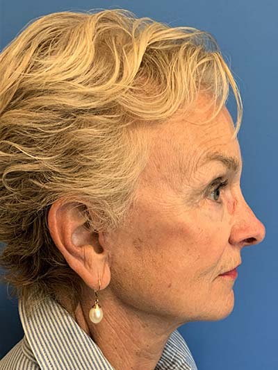 Face & Neck Lift