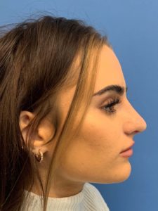 Rhinoplasty after photo by Gardner Facial Plastic Surgery in St. George, Utah