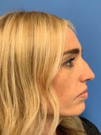 Rhinoplasty