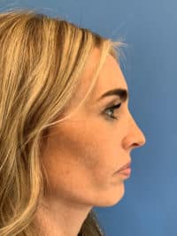 Rhinoplasty