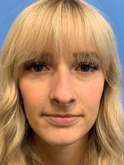 Rhinoplasty Case 781 Before Photo Rhinoplasty