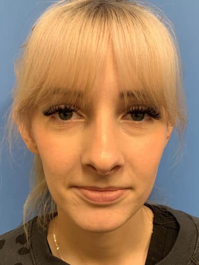 Rhinoplasty Case 781 After Photo Rhinoplasty