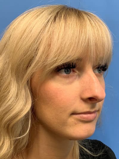 Rhinoplasty Case 781 Before Photo Rhinoplasty