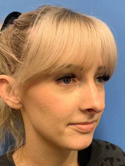 Rhinoplasty Case 781 After Photo Rhinoplasty