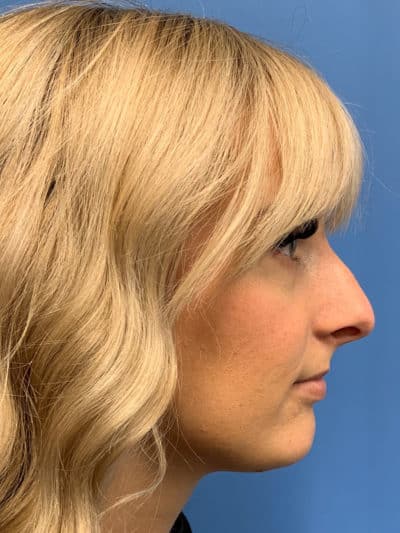 Rhinoplasty Case 781 Before Photo Rhinoplasty
