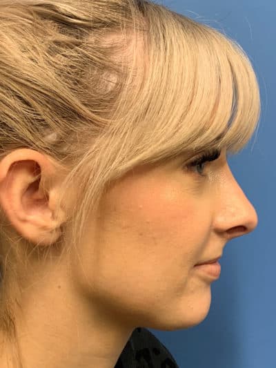 Rhinoplasty Case 781 After Photo Rhinoplasty