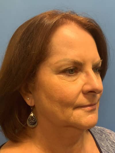 Face & Neck Lift Case 793 Before Photo Face & Neck Lift