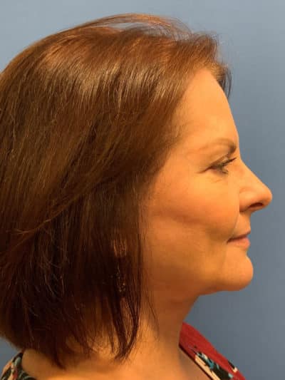 Face & Neck Lift Case 793 After Photo Face & Neck Lift