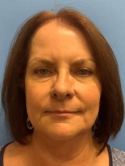 Face & Neck Lift Case 793 Before Photo Face & Neck Lift
