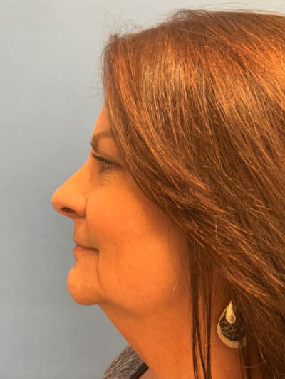 Face & Neck Lift Case 793 Before Photo Face & Neck Lift