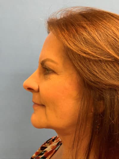 Face & Neck Lift Case 793 After Photo Face & Neck Lift