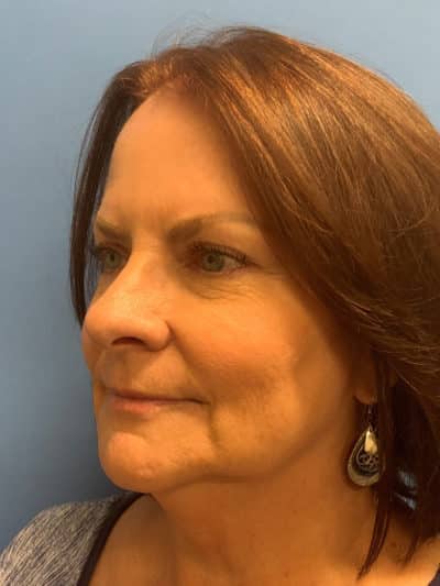 Face & Neck Lift Case 793 Before Photo Face & Neck Lift