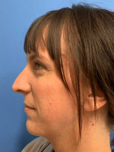 Rhinoplasty Case 832 Before Photo Rhinoplasty