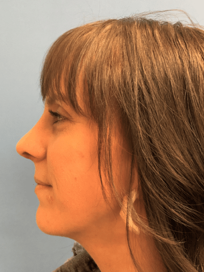 Rhinoplasty Case 832 After Photo Rhinoplasty
