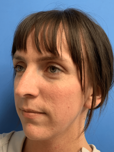 Rhinoplasty Case 832 Before Photo Rhinoplasty
