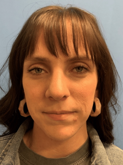 Rhinoplasty Case 832 After Photo Rhinoplasty