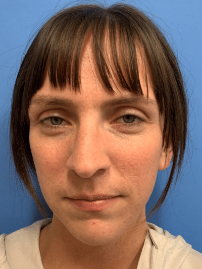 Rhinoplasty Case 832 Before Photo Rhinoplasty