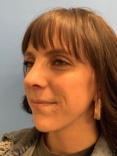 Rhinoplasty Case 832 After Photo Rhinoplasty
