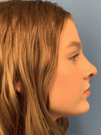 Rhinoplasty