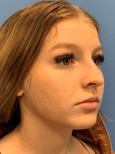 Rhinoplasty Case 841 Before Photo Rhinoplasty