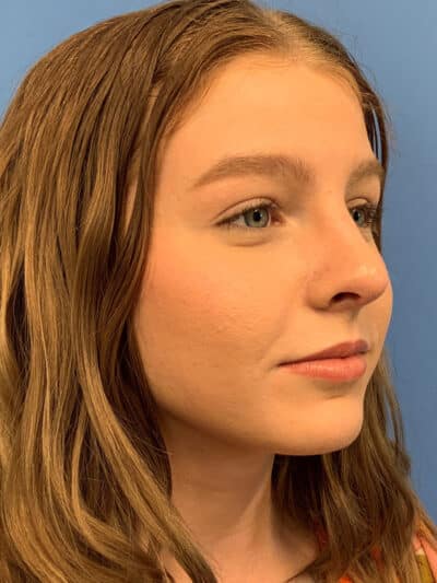 Rhinoplasty Case 841 After Photo Rhinoplasty
