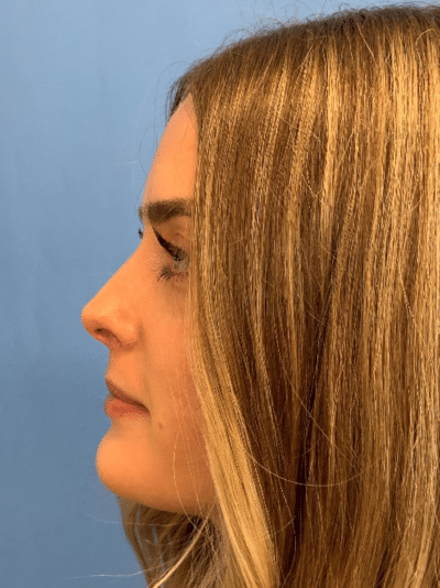 Rhinoplasty