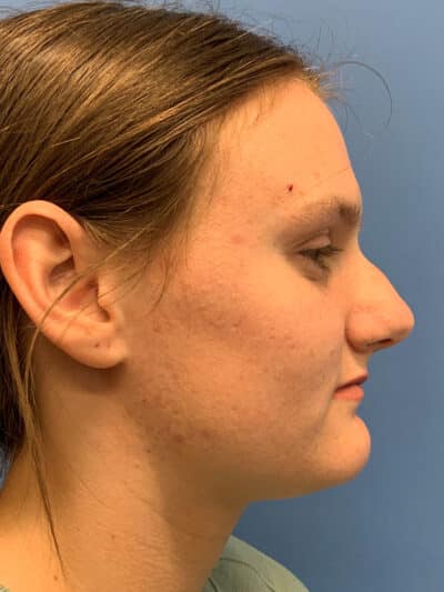 Rhinoplasty