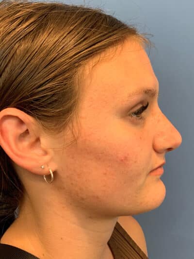 Rhinoplasty