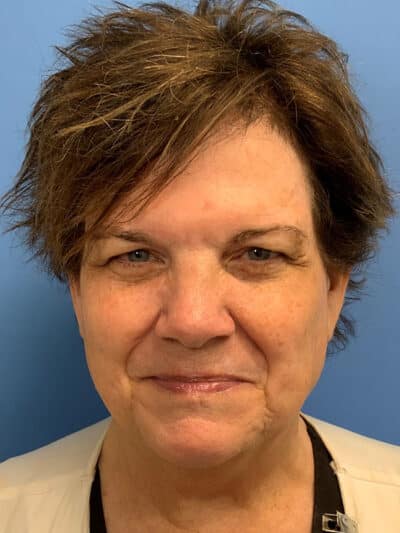 Blepharoplasty & Browlift Case 871 Before Photo Blepharoplasty & Browlift