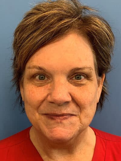 Blepharoplasty & Browlift Case 871 After Photo Blepharoplasty & Browlift