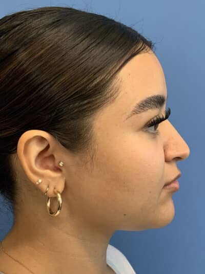 Rhinoplasty