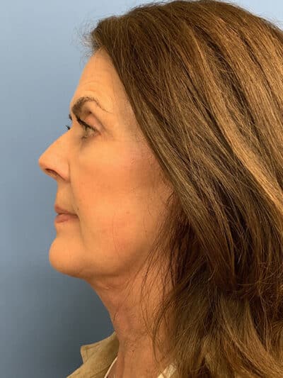 Blepharoplasty & Browlift