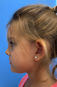 Otoplasty/Ear Pinning