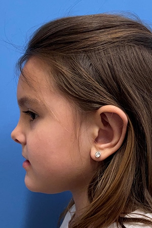 Otoplasty/Ear Pinning