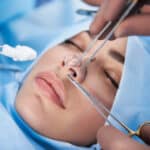 a person having rhinoplasty
