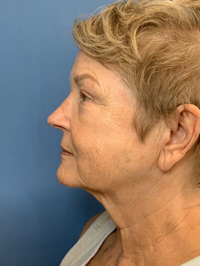 Blepharoplasty & Browlift