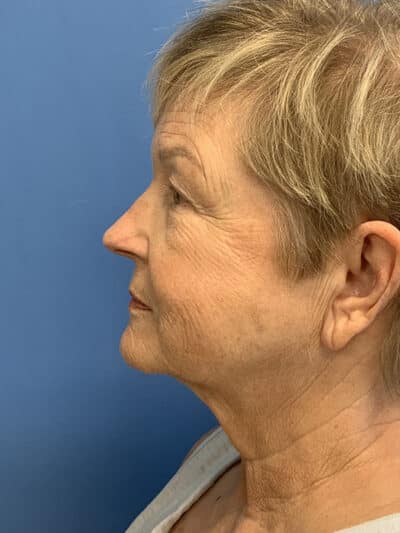 Blepharoplasty & Browlift