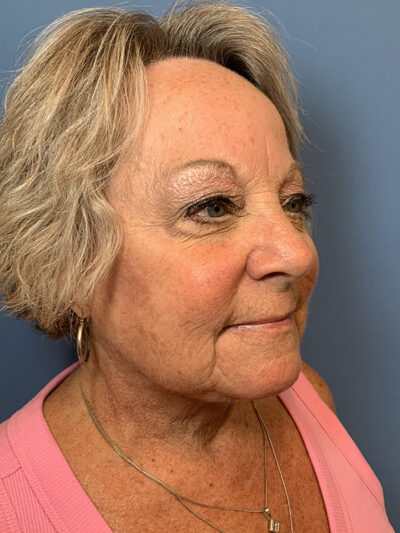 Face & Neck Lift