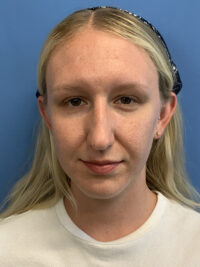 Rhinoplasty