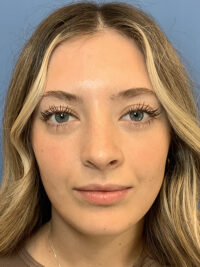 Rhinoplasty