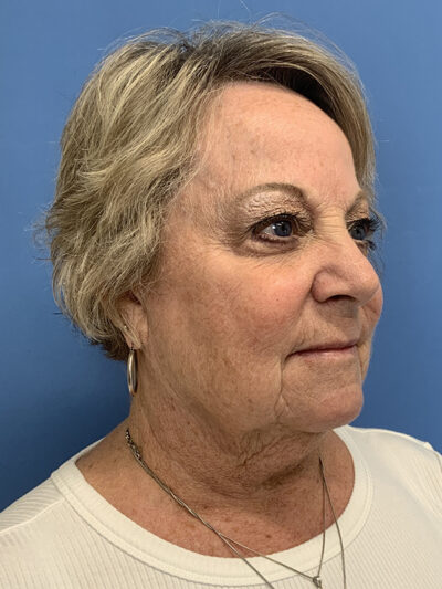 Face & Neck Lift