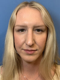 Rhinoplasty