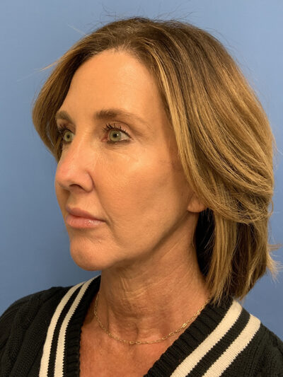 Chin Augmentation Case 37596 After Photo Chin Augmentation