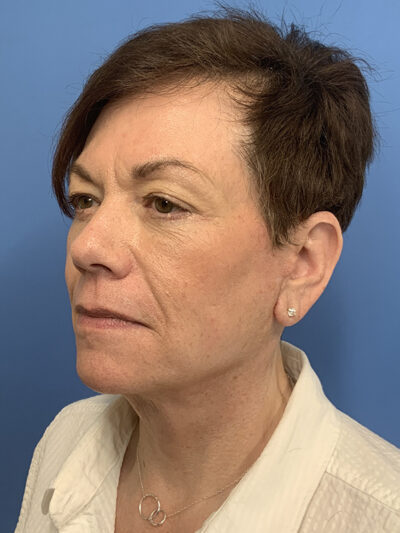 Face & Neck Lift Case 37590 After Photo Face & Neck Lift