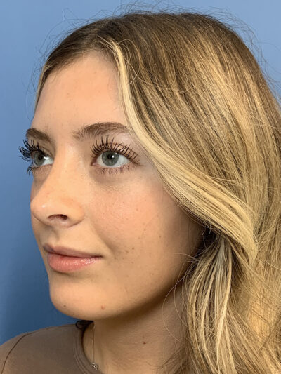 Rhinoplasty