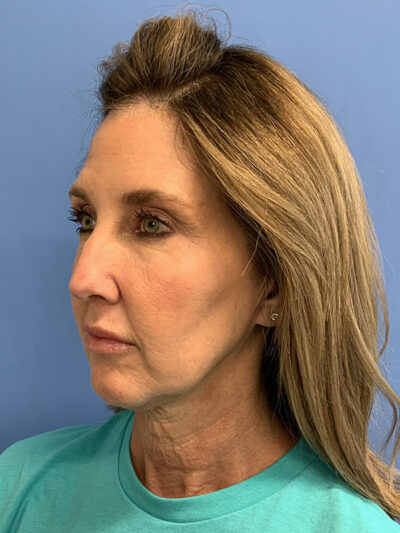 Chin Augmentation Case 37596 Before Photo Chin Augmentation