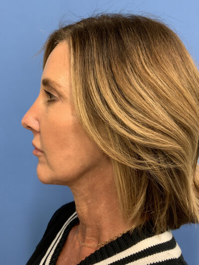 Chin Augmentation Case 37596 After Photo Chin Augmentation