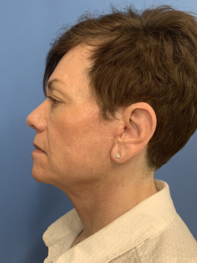 Face & Neck Lift Case 37590 After Photo Face & Neck Lift