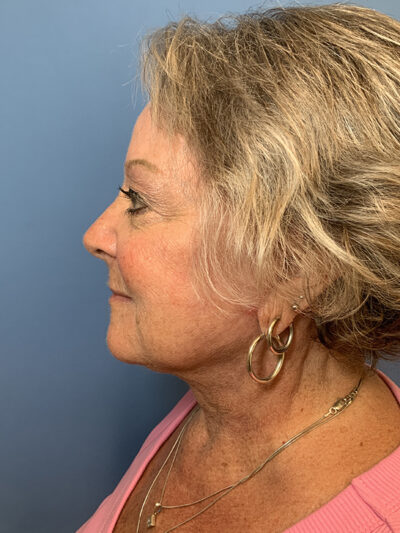 Face & Neck Lift
